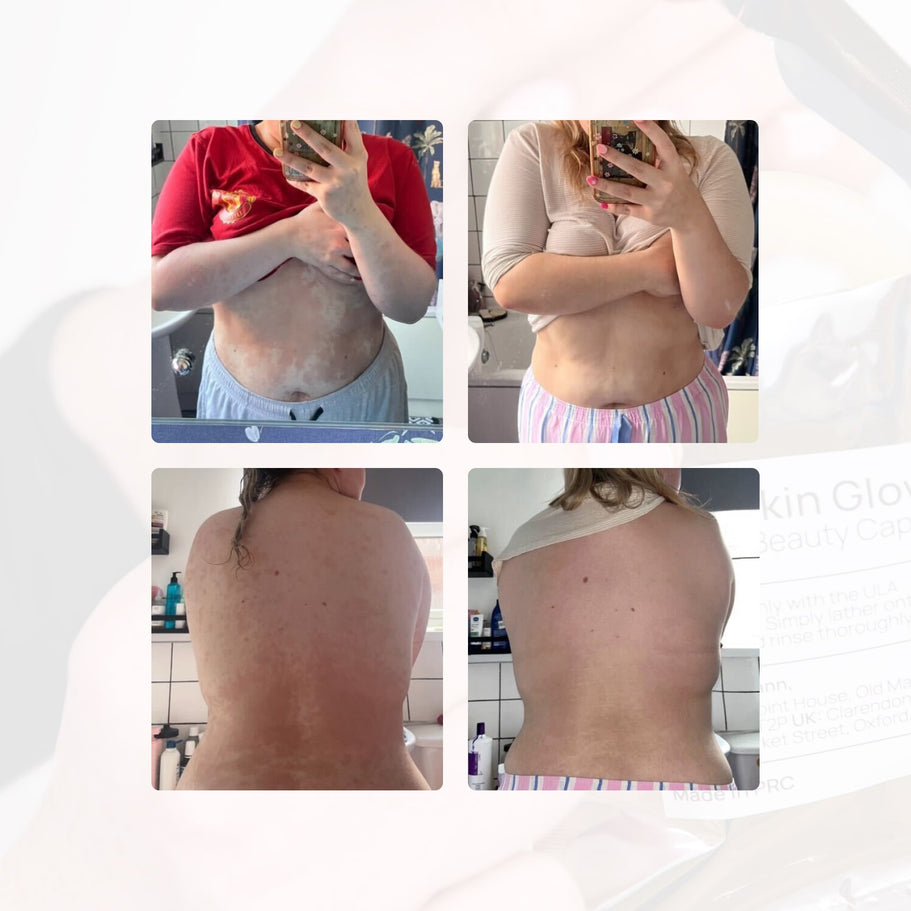 Customer testimonial collage showing before-and-after results for psoriasis on skin and hair improvement after two weeks using ULA shower filter and Argan Oil capsule.